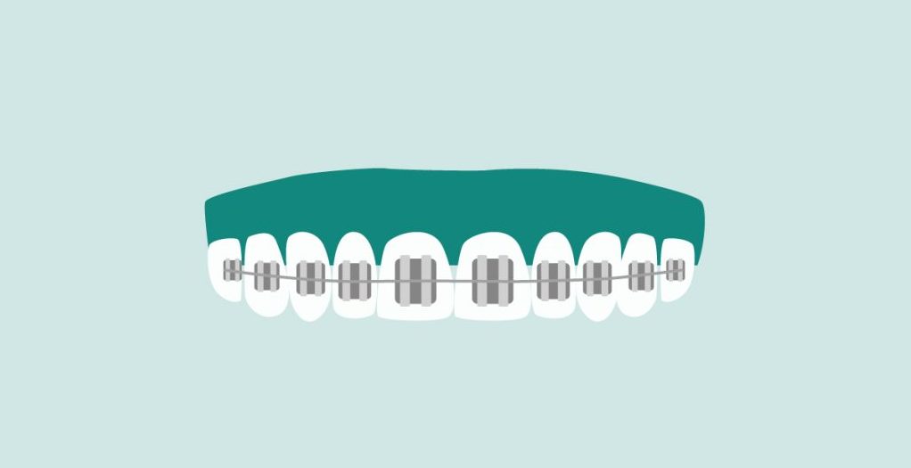 brackets-metalicos-madrid