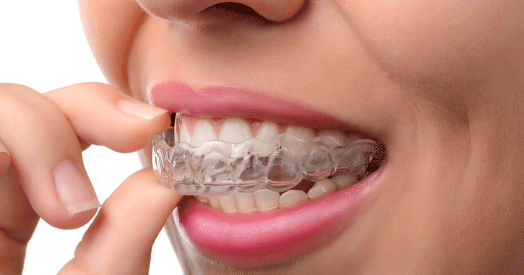 tipos de brackets autoligables esteticos