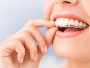 Precio de Invisalign: cómo calcular el coste del tratamiento