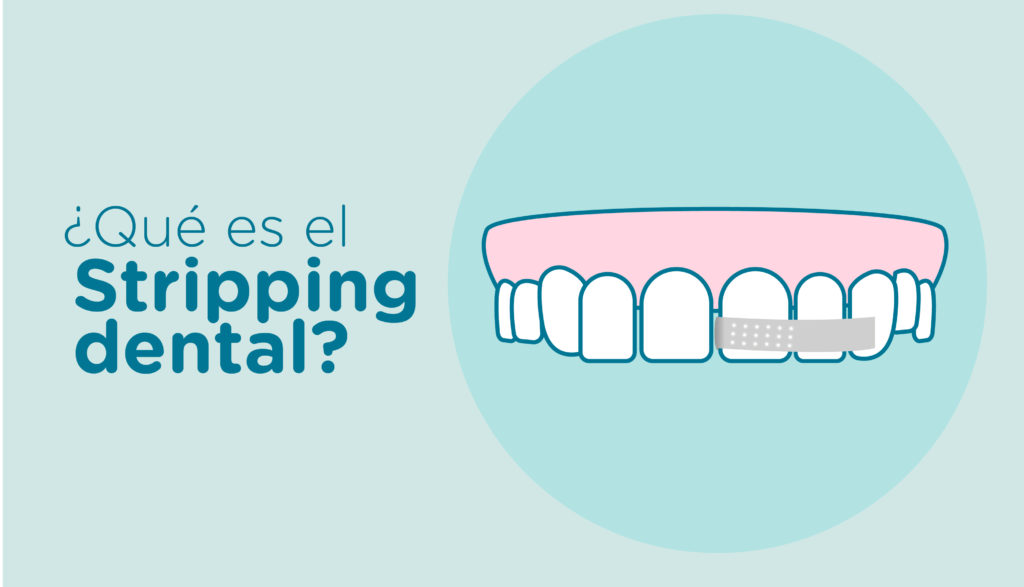 Stripping Dental Qué es y para qué se utiliza Clínica dental Soria