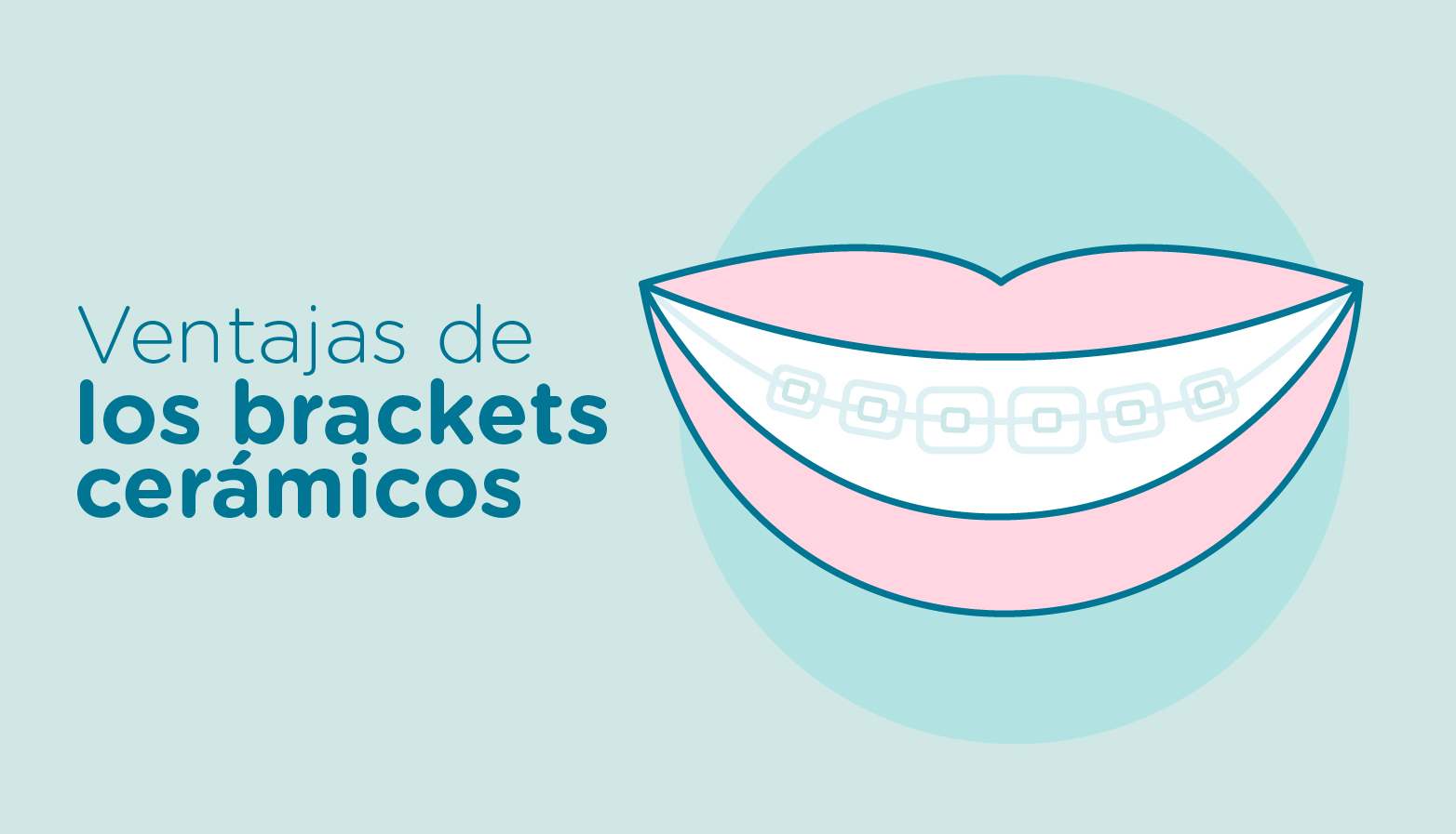 Brackets Cerámicos de porcelana La alternativa estética más eficaz
